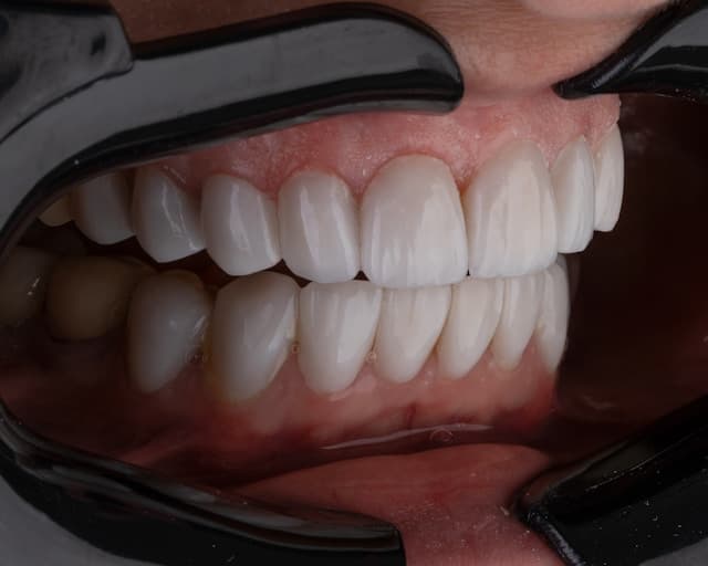 Dentures (Complete & Partial)